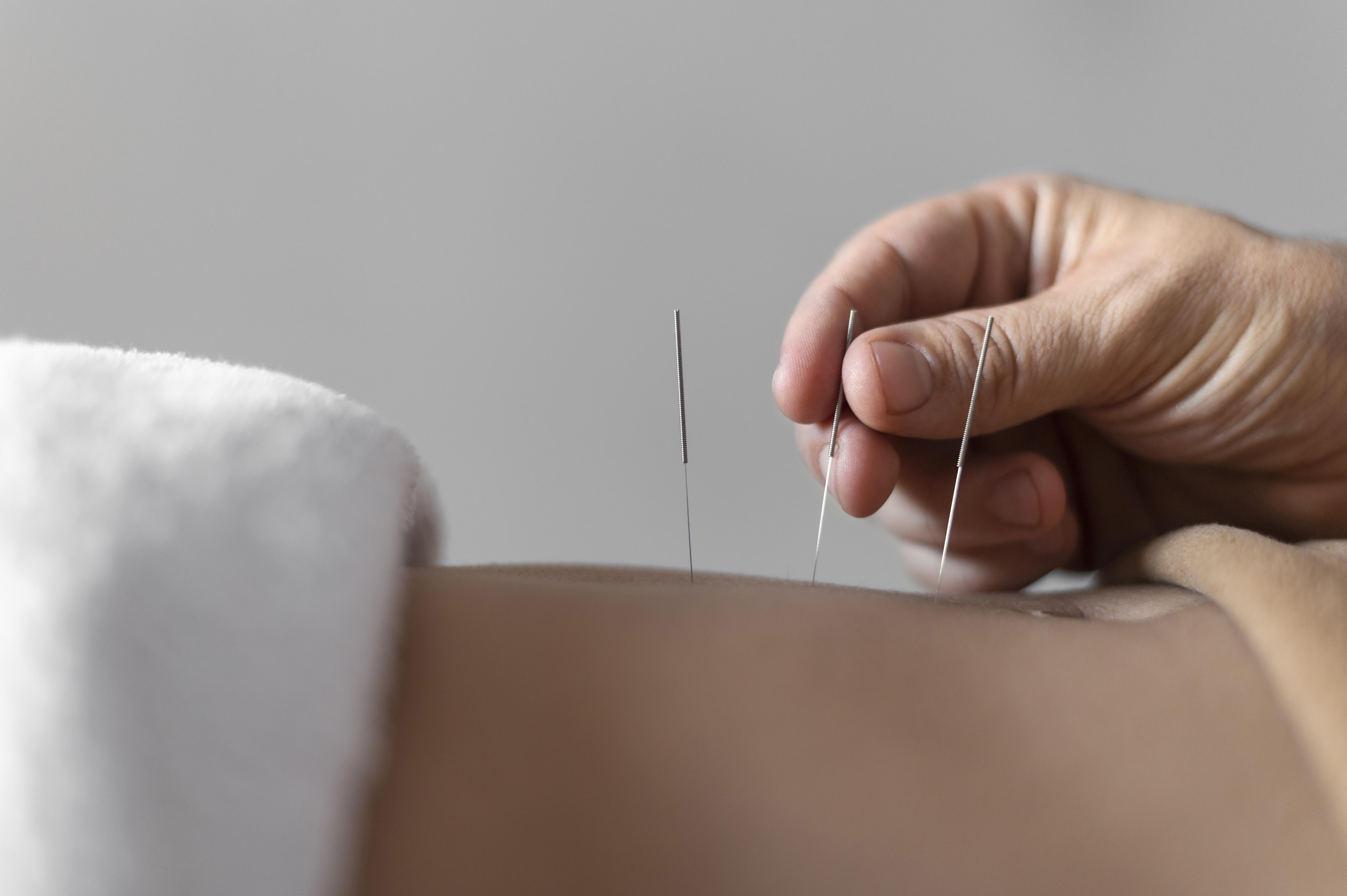 TCM Slimming Acupuncture Treatment